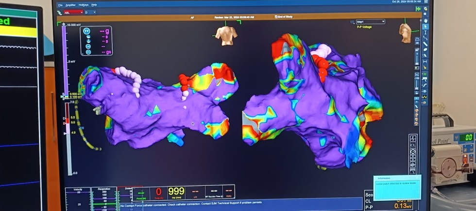 Technologia mapowania serca 3D w Szpitalu w Sztumie – nowoczesny zabieg w portfolio Szpitala
